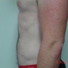 Abdomen After #3