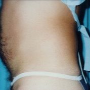 Abdomen Before #2