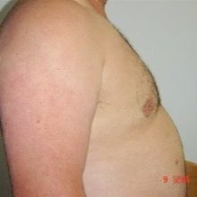 Chest After #8