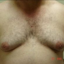 Chest Before #5