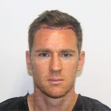 Shane_before